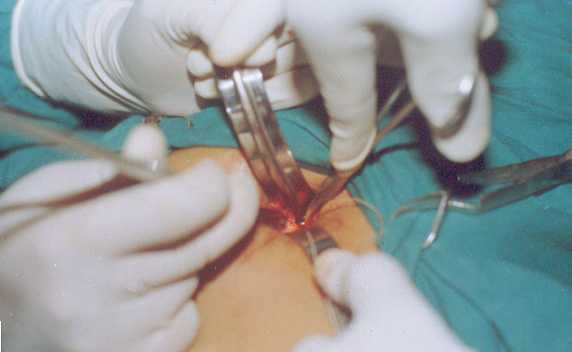 Gall Bladder Incision Showing Cystic Duct Ligation